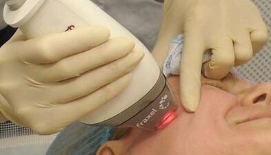 Ako prebieha frakčné omladenie pleti