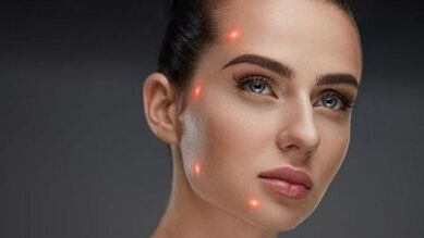 Čo je to frakčné omladenie pleti