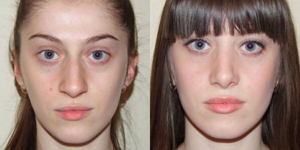 Dievča pred a po plazmovom omladení pokožky tváre