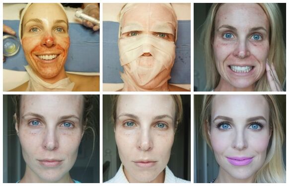 Etapy hojenia pokožky tváre po úspešnom plazmovom liftingu