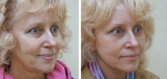 Žena pred a po plazmovom omladení pokožky tváre